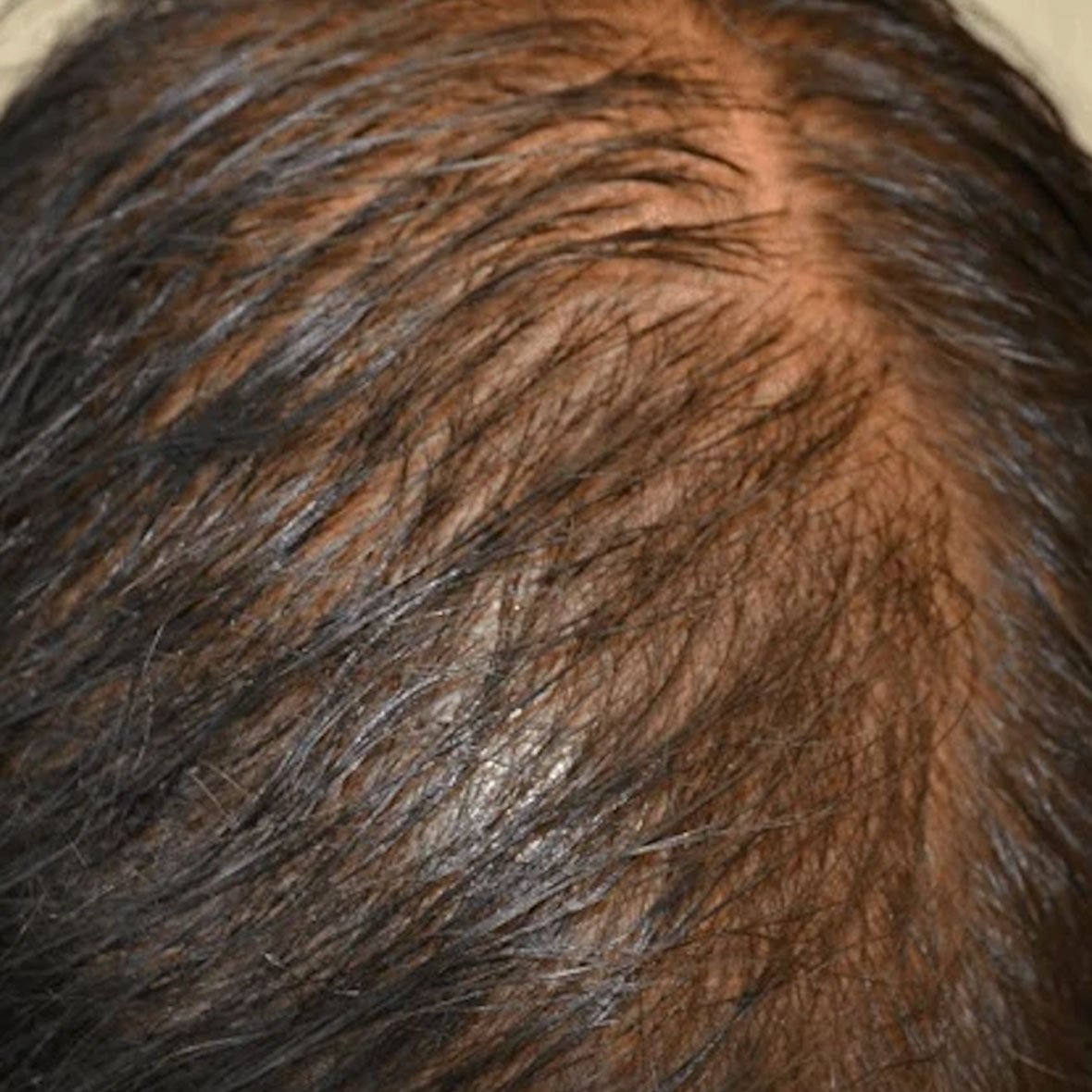 Dr Mehdi Lahbabi - Traitements PRP et PRF - Avant