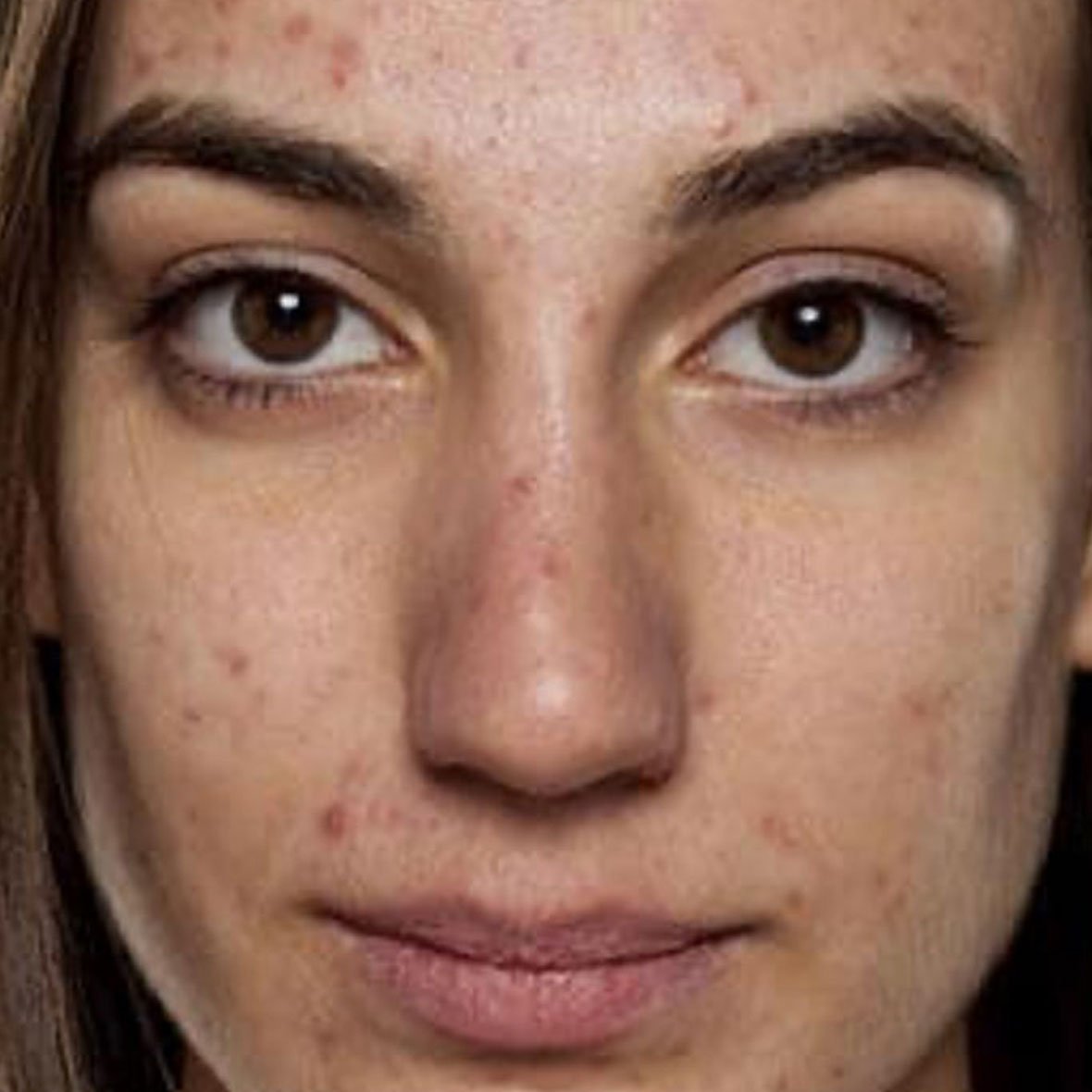 Dr Mehdi Lahbabi - Hydrafacial - Avant