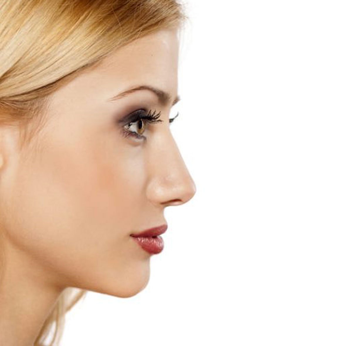 Dr Mehdi Lahbabi - Rhinoplastie médicale - Après