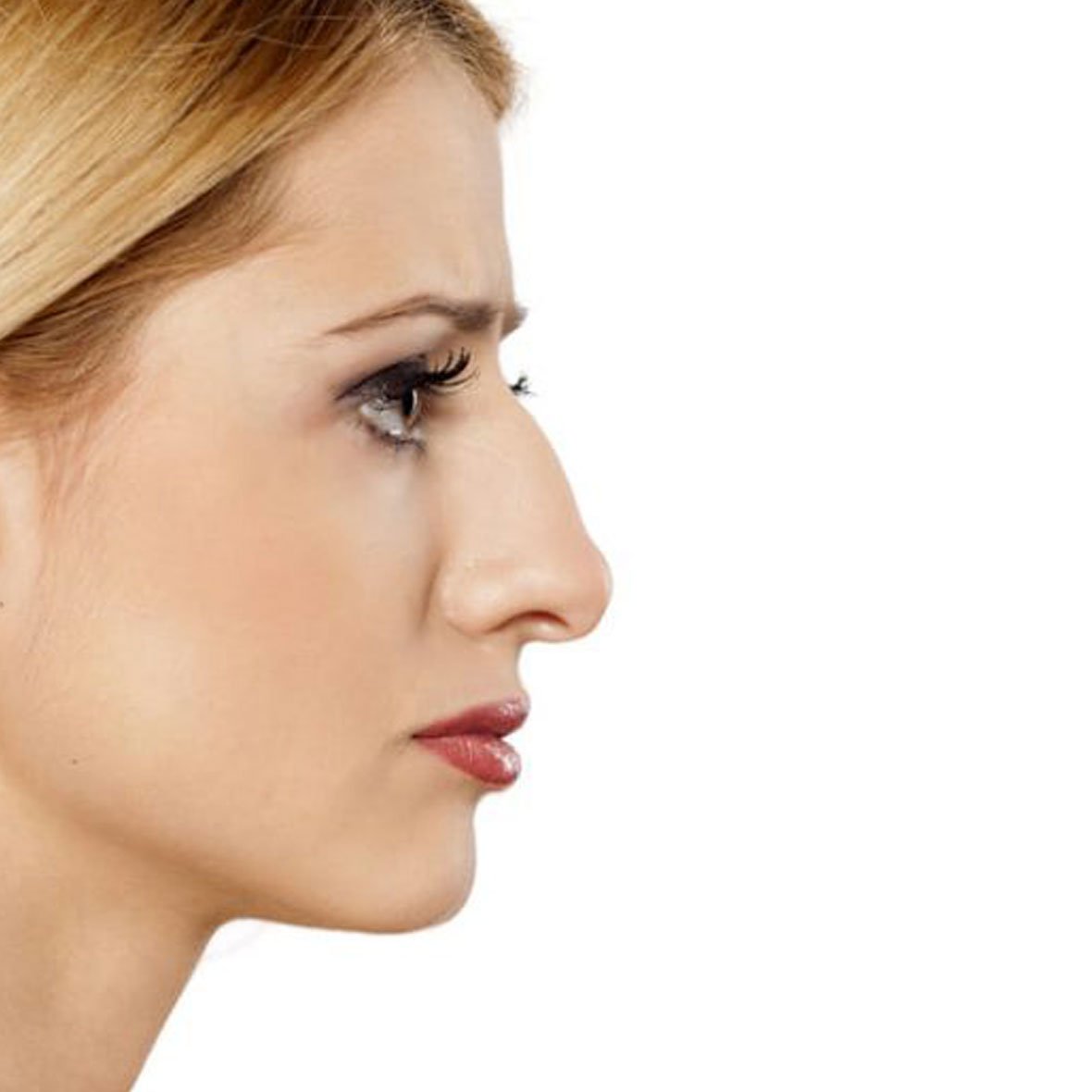 Dr Mehdi Lahbabi - Rhinoplastie médicale - Avant